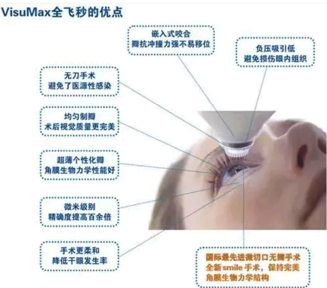 全飞秒激光手术smile是什么?
