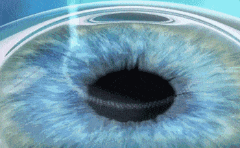 来自屈光医生的摘镜指南:近视眼手术,全飞秒、半飞秒哪个更好? 来自屈光医生的摘镜指南:近视眼手术,全飞秒、半飞秒哪个更好?